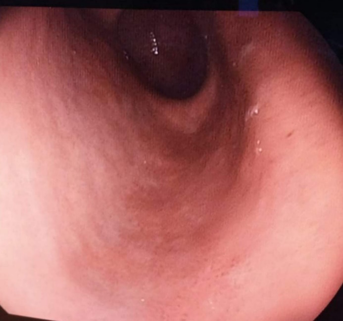 Figure 5: Direct mink gastroscopy showing normal looking gastric mucosa.
