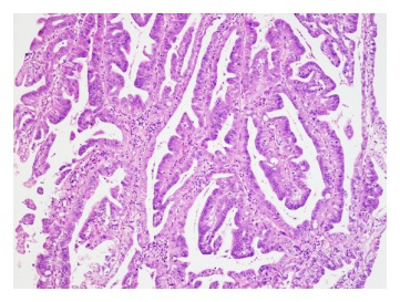 Figure 1: Intraductal papillary neoplasm of bile ducts composed of micro-papillary articulations with s distinct fibro-vascular stalk layered by intestinal epithelium with minimal cytological atypia [5].