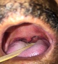 Figure 2: Aspect of the oropharynx after twenty days of treatment.