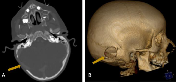 Figure 1: ** Head CT in bone window (A) with three-dimension reconstruction (B) shows a well-defined, rounded bone defect involving the left lambdoid suture (yellow arrow).