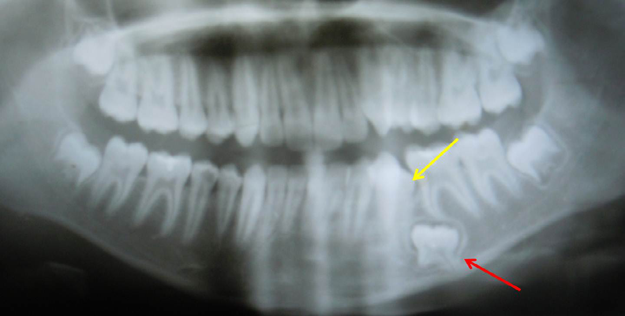 Figure 4: Orthopantomograph showing deeply impacted primary mandibular left second molar (red arrow). Erupting second premolar can also be seen (yellow arrow).