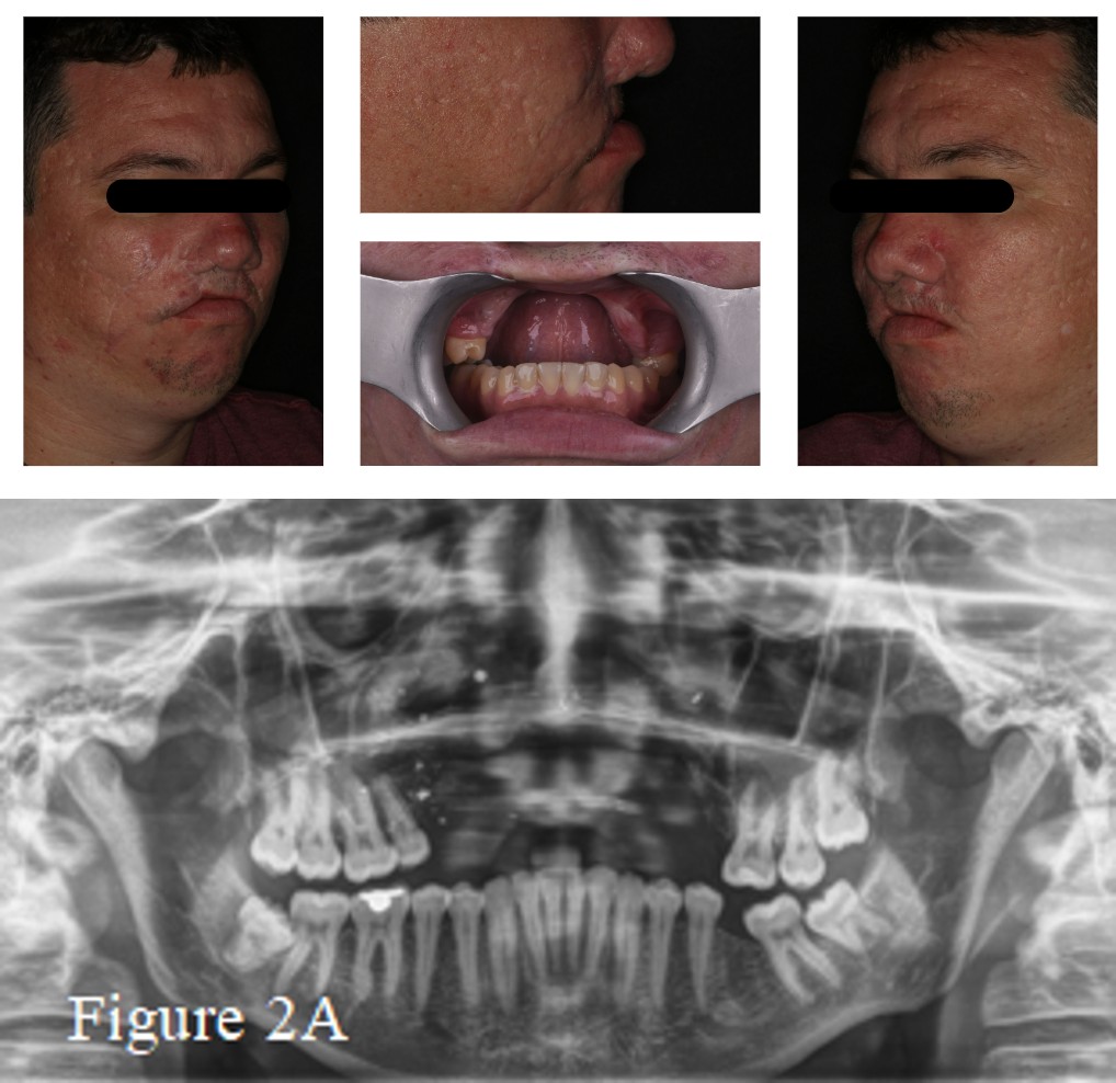 Figure 1: The patient had a concave facial profile with loss of the vertical dimension of occlusion due to extensive tooth loss, as well as loss of upper lip volume and the presence of an inverted smile which promotes an ageing appearance, revealing facial and skeletal disharmony.