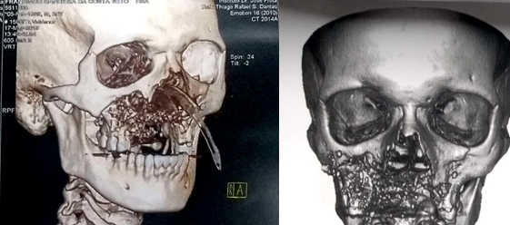 Figure 2: Radiologic and clinical examination revealed an extensive bone defect in the anterior region of the maxilla, with the loss of several teeth and part of the alveolar bone structure.