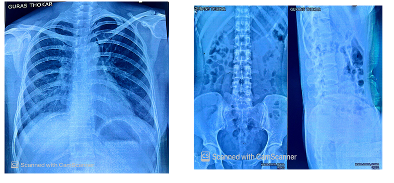 Figure 1: Chest x-ray and Lumbo-sacral x-ray.