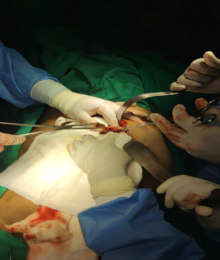 Figure 1: Shows an upper midline laparotomy with an opened stomach with the end of a toothbrush.
