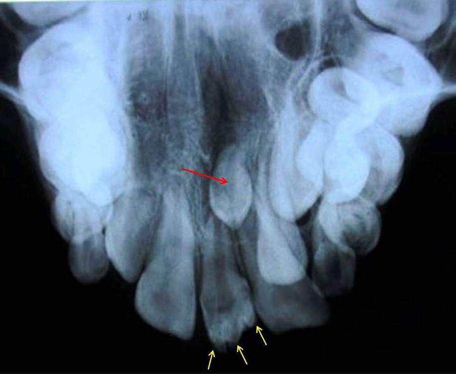 Figure 2: Occlusal Radiograph Showing Presence of Three Talon Cusp (Yellow Arrows) and Vertical Impacted Supernumerary Tooth (Red Arrow).
