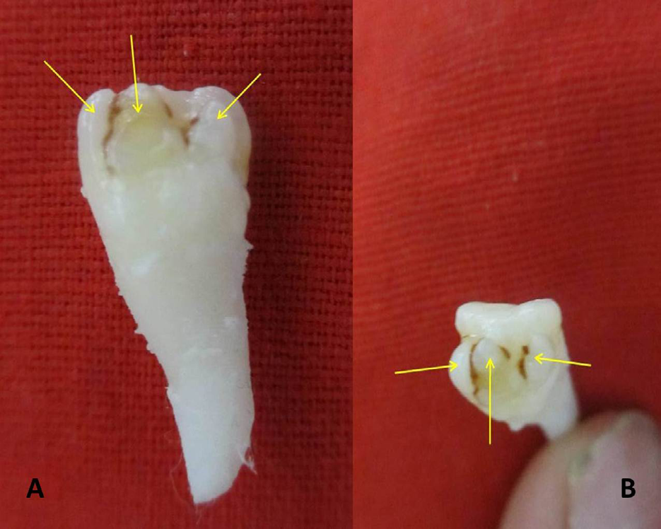 Figure 3: Extracted Mesiodens Showing Labial Triple Talon Cusps (Yellow Arrows), of Unequal Size and Well Separated by Developmental Grooves – Categorized as Type 6, B Based on Author’s New Revised Classification (A – From Labial View, B – From Incisal View).