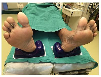 Figure 3: Silicone gel bed placed under the pressure point of the feet.