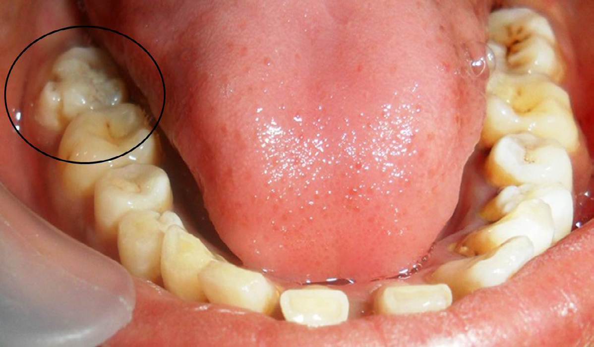 Figure 1: Intraoral photograph showing presence of an accessory cusp like structure attached to the buccal surface of the mandibular right second molar (mesiobuccal cusp) (black circle).