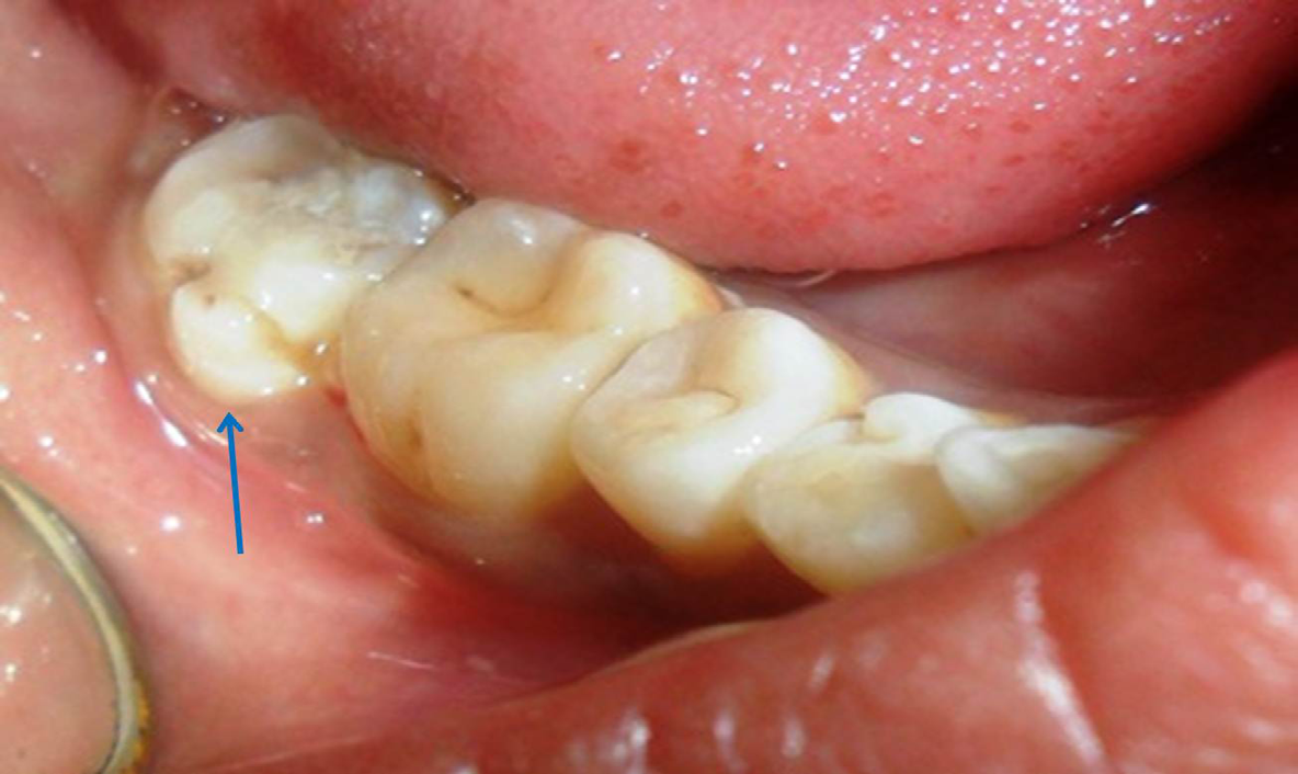 Figure 2: Photograph showing protostylid attached to the mesiobuccal cusp of mandibular right second molar with deep developmental groove (blue arrow). Protostylid is extending from cervical margin to the middle third of the mesiobuccal cusp.
