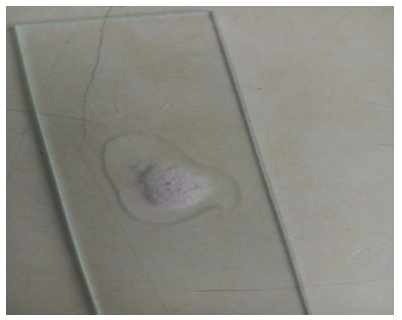 Figure 4: Positive Catalase Test in the study.
