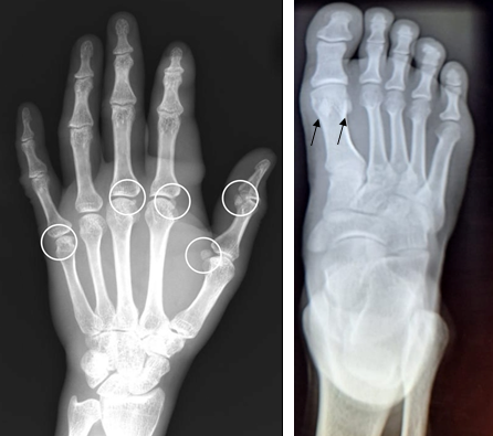 Figure 1: Radiographs of hand and foot demonstrating sesamoid bones.