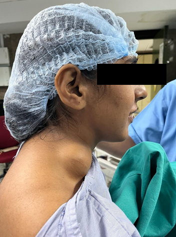 Figure 1: Cystic Swelling over Left Lateral.