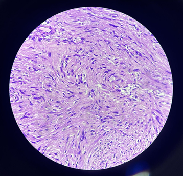 Figure 3: Histopathology of the Cyst Wall Suggestive of a Schwannoma.