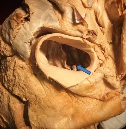 Figure 2: Picture of bicuspid aortic where V-shaped cuspal margins are not visible in the raphe (arrow).