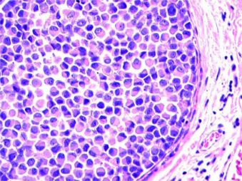 Figure 2: Pleomorphic lobular carcinoma in situ delineating lobular expansion with tumour cells pervade with abundant, eosinophilic cytoplasm, intracytoplasmic mucin and pleomorphic nuclei with variable outlined and prominent nucleoli [6].