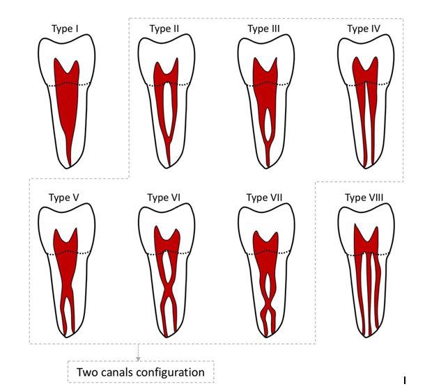Figure 1: Schematic picture showing Vertucci’s different root canal system [7].