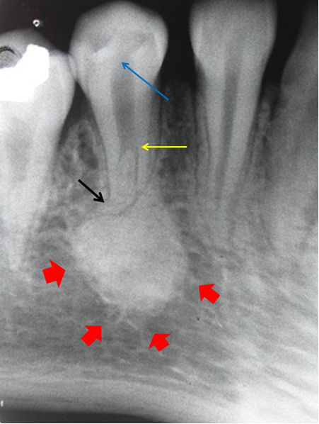 Figure 2: Radiograph showing mandibular right first premolar with carious lesion involving dental pulp (blue arrow), Vertucci’s Type V root canal configuration (1-2) (yellow arrow) and severe root dilaceration of 80-degree bend at the root apex (black arrow). A round shaped radiopaque dense mass measuring 20 mm size can be seen attached to the root apex (red arrows)