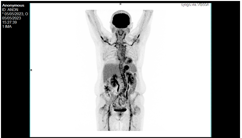 Figure 1: Intense hypermetabolism of the walls of large vessels.