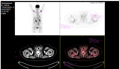 Figure 2: Slightly moderate periarticular fixation in shoulder projection.