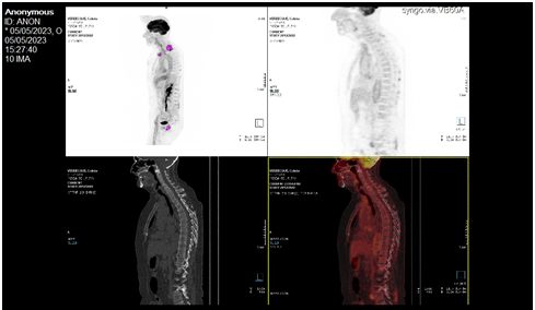 Figure 3: Hyperfixation opposite tendon insertions in the cervical and dorsal multistage spinous processes.