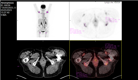 Figure 4: Slightly intense hypermetabolic activity in projection of the ischials.