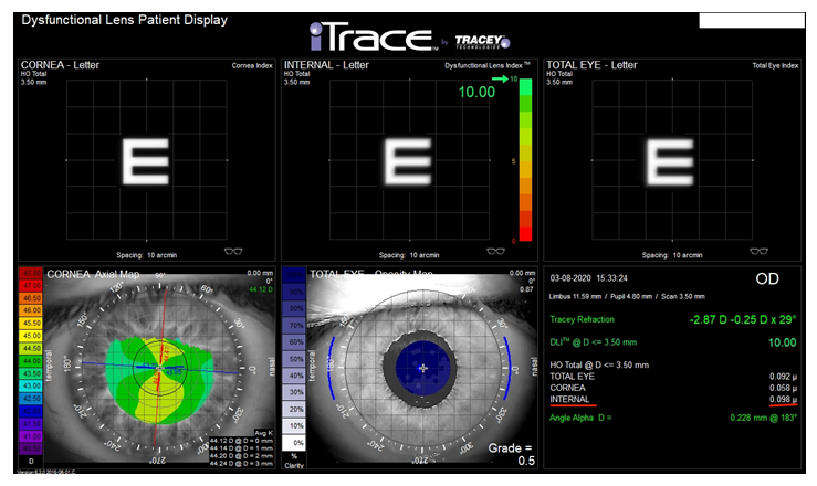 Figure 1: An example test result using one of the modules available in the iTrace analyser - Dysfunctional Lens Patient Display. It graphically shows how individual elements of the optical system, i.e. the cornea (top left) and the lens (top centre) and both elements together (top right) reproduce the quality of letter “E”, taking into account the HOA values generated by these structures. The HOA values are shown in numerical form below (bottom right). The value of HOA Internal generated by the lens is marked with a red line.