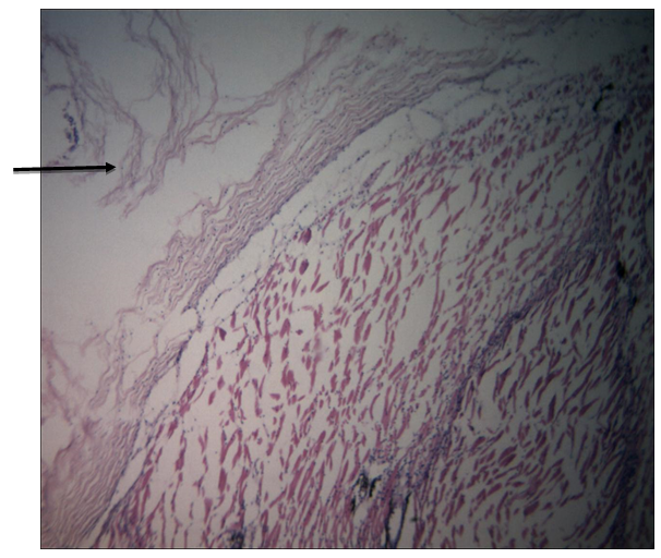 Figure 2: Skin of infected juvenile showing erosion of entire epidermis (black arrow) (H&E X 400).