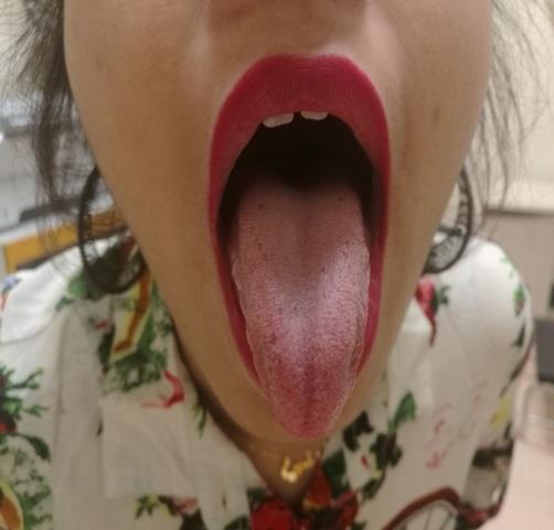 Figure 2: Patients tongue 2 weeks after stopping Hyroxyurea.