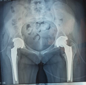 Figure 5: Rx of the pelvis of the same patient after arthroplasty.