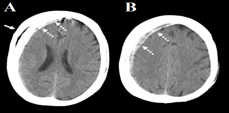 Figure 2: A 51-year-old male patient suffered an episode of epilepsy and he underwent a CT scan which shows the following; A- an axial brain CT scan shows what looks like as a subdural hemorrhage (the intermittent arrow) and the right part of the skull is seen split into two which is due to the slight movement (the continuous arrow), and B- a brain axial scan shows what appears to be a subdural hemorrhage (the intermittent arrow). The case appears normal and due to the fact that patient is irresponsive, no other imaging was done and he was admitted under observation for 48 hours then discharged after he improved.
