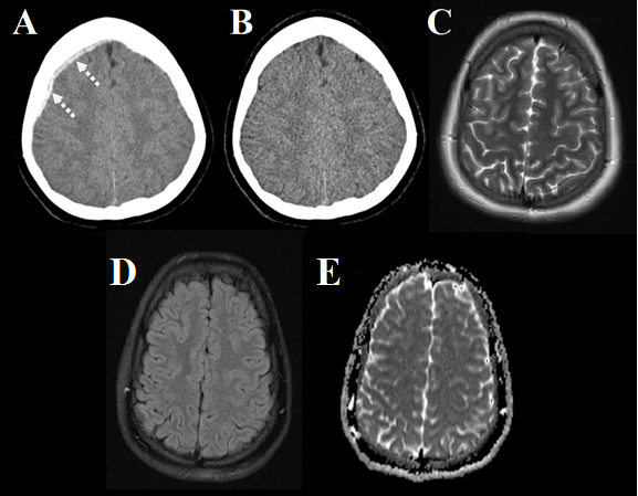 Figure 3: A 19-year-old female patient who fell down and underwent brain scans which shows the following; A- an axial brain scan shows a subdural hemorrhage on the right side (the intermittent arrow), B- a repeated axial brain CT scan shows a normal brain, C- a brain MRI T2 image shows no abnormality, D- a brain MRI FLAIR image shows no abnormality, and E- a brain MRI ADC map shows no abnormality.