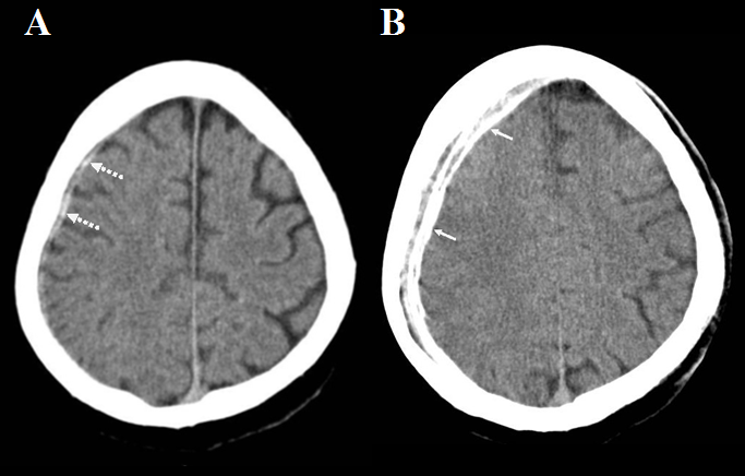 Figure 4: A 44-year-old male patient’s brain CT scan shows; A- an axial brain CT which shows a sign that mimics a subdural hemorrhage, and B- an axial brain CT shows motion artifact on the right side which indicated that there is no subdural hemorrhage.