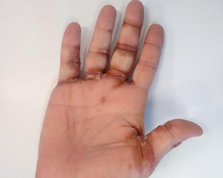 Figure 1: Involvement of flexures of hand.