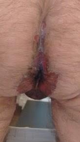 Figure 4: Perianal involvement.