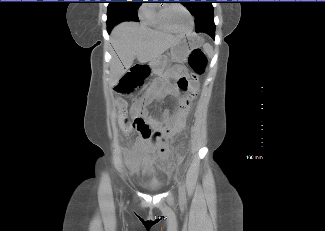 Figure 1: Computed Tomography Scan of Abdomen/Pelvis at Presentation.