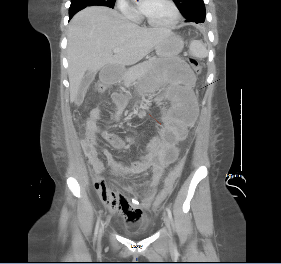 Figure 2: Repeated Computed Tomography Scan of Abdomen/Pelvis After Initial Intravascular Antibiotics.