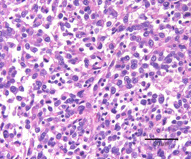 Figure 3: Colonic metastasis of pulmonary carcinosarcoma in a cat. The lesion has loose sheets of oval to round neoplastic cells with hypereosinophilic cytoplasm and eccentrically-placed nuclei. Hematoxylin & eosin. Scale bar = 50 μm.