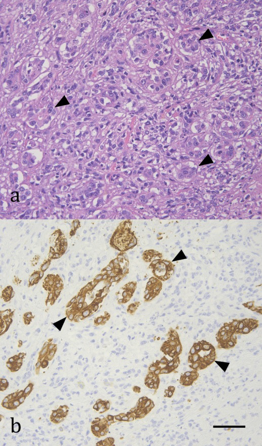 Figure 4: Carcinosarcoma metastasis to the left ventricular myocardium in the heart of a cat. (a) Epithelial components form acinar-like structures (arrowheads). Hematoxylin & eosin. (b) The epithelial cells that form the acini (arrowheads) are strongly positive for a broad keratin marker. Immunohistochemical antibody anti-cytokeratin AE1/AE3. Scale bar = 50 μm.