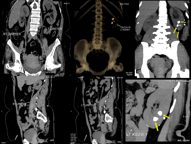 Figure 1: The scan time for MRA as compared to CTA is high, and due to low spatial resolution and small coverage can result in missing the small accessory arteries arising from pelvic vessels. The better spatial resolution, faster speed and using Surestart bolus tracking minimize the chances of missing any small tributaries in CTA as depicted in Figures 2-4.