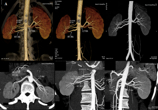 Figure 2: Arterial phase depicting the arterial anatomy; three right renal arteries, two accessory renal arteries coursing towards the right upper renal pole; the main right renal artery measuring approximately 4.5 mm, with an arterial diameter at the origin site of 12mm, and one left renal artery that measures about 5.5mm, with an arterial diameter of 10mm, from their origin till their first segmentary bifurcation. (A) 3D semi-transparent background images (B) 3D transparent background images (C) coronal MIP images (D) curved MPR showing both the right accessory artery and left renal artery on axial (E) oblique coronal showing right renal artery as well as the accessory renal artery (F) showing the left renal artery.