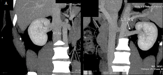Figure 3: Venous phase depicting the veins, the main left renal vein courses anterior to the aorta measuring about 25 mm from IVC to hilum. The distance between the confluence of the left renal vein and the left margin of the aorta is 40 mm and a single right vein at the renal hilum drains into the IVC which measures 62 mm from the IVC to the hilum. The left gonadal and lumbar veins drain into the left renal vein. The right gonadal and lumbar veins drain directly into the IVC. (A) Showing an oblique of the right renal vein (B) showing the oblique of the left renal vein.