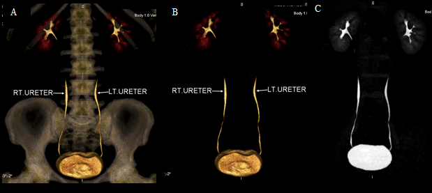 Figure 4: Excretory phase depicting the renal collecting system and the ureters without any abnormal dilatation or filling defect, (A) 3D semi-transparent background image (B) 3D transparent background image (C) coronal MIP image.