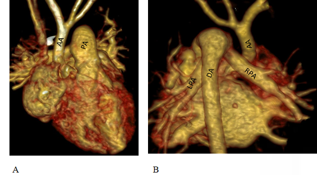 Figure 1: Cardiac CT, VRT reconstructed images; (A-anterior view): Aorta (AA) arising from left ventricle with normal branching of aortic arch. Interruption of aorta is noted distal to the origin of left subclavian artery. Pulmonary artery (PA) appears dilated. (B-posterior view): Descending aorta (DA) is opacified via large patent ductus arteriosus (PDA) from the pulmonary trunk. Right and left pulmonary arteries are also seen in this view (RPA and LPA).