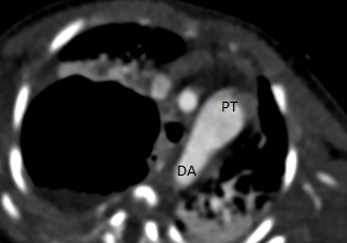 Figure 2: Axial CT image: patent ductus arteriosus (asterisk) between the pulmonary trunk (PT) and descending aorta (DA).