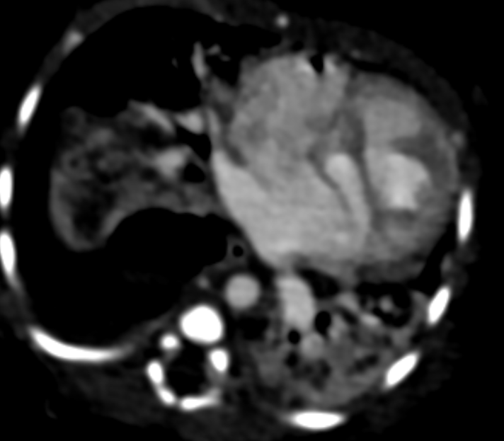 Figure 3: Contrast enhanced chest CT, axial view, and mediastinal window: Abnormal communication (black arrow) between right and left ventricles representing ventricular septal defect (VSD).