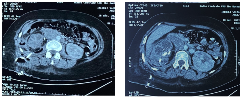 Figure 1: CT abdomen transverse plane shows right emphysematous pyelonephritis with peri- and para-renal collections and air foci, and right psoas abcess Class 3B. Panel A: the right kidney is shunted by a DJ stent. Panel B: the perinephric abcess is shunted by a drain.