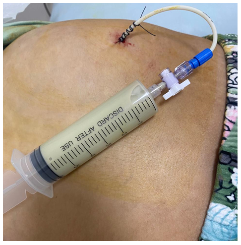 Figure 2: A pigtail drain placed in the perinephric space to drain perinephric abscess.