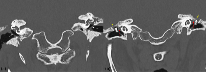 Figure 2: Coronal reformatted images of NCCT show thickened tympanic membrane (white arrow), opacified middle ear cavity (red arrow), and irregular bony erosion of tegmen tympani (yellow arrows).