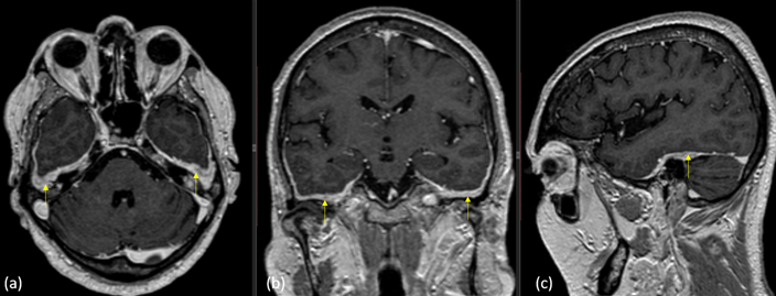 Figure 3: T1 post contrast axial (a), coronal (b) and sagittal (c) images show bilateral symmetrical thickening and enhancement of the dura along the middle cranial fossa in relation to the temporal lobes (yellow arrows).